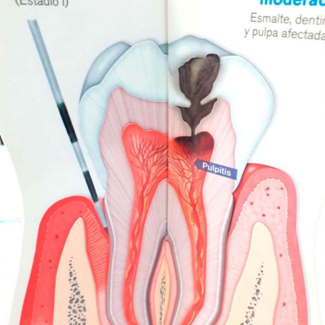 Diagnóstico biológico de la caries