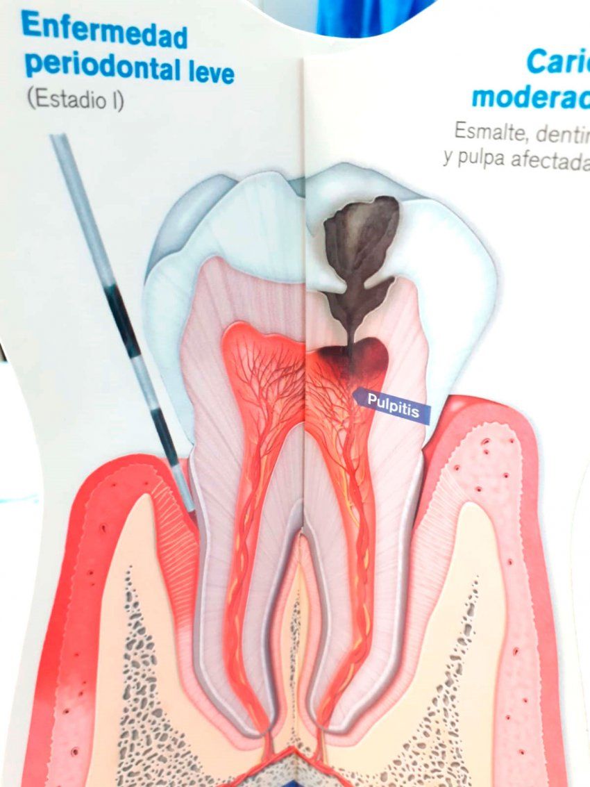 Diagnóstico biológico de la caries