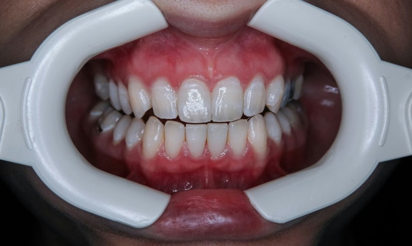 estetica dental en coslada