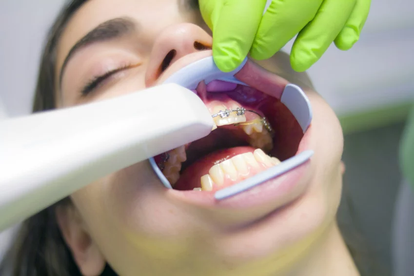 Esc&aacute;ner intraoral